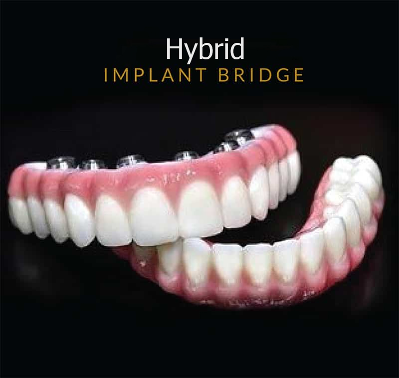 hybrid implant bridge