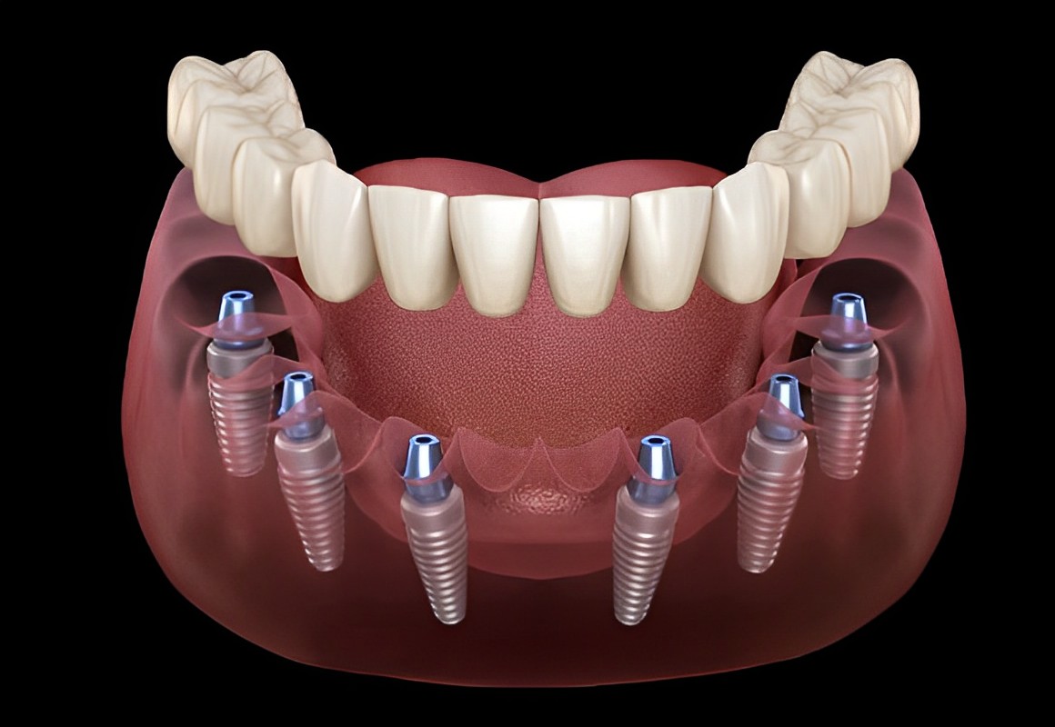 Ziriconia Implant Bridge